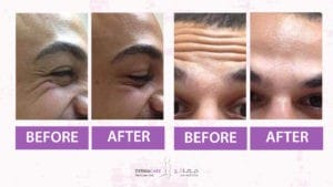 Botox Treatement