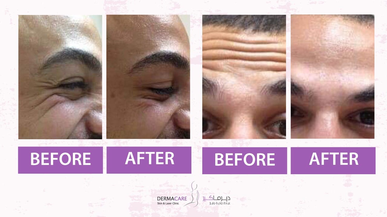 Botox Treatement