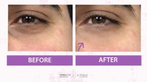 Filler Treatment