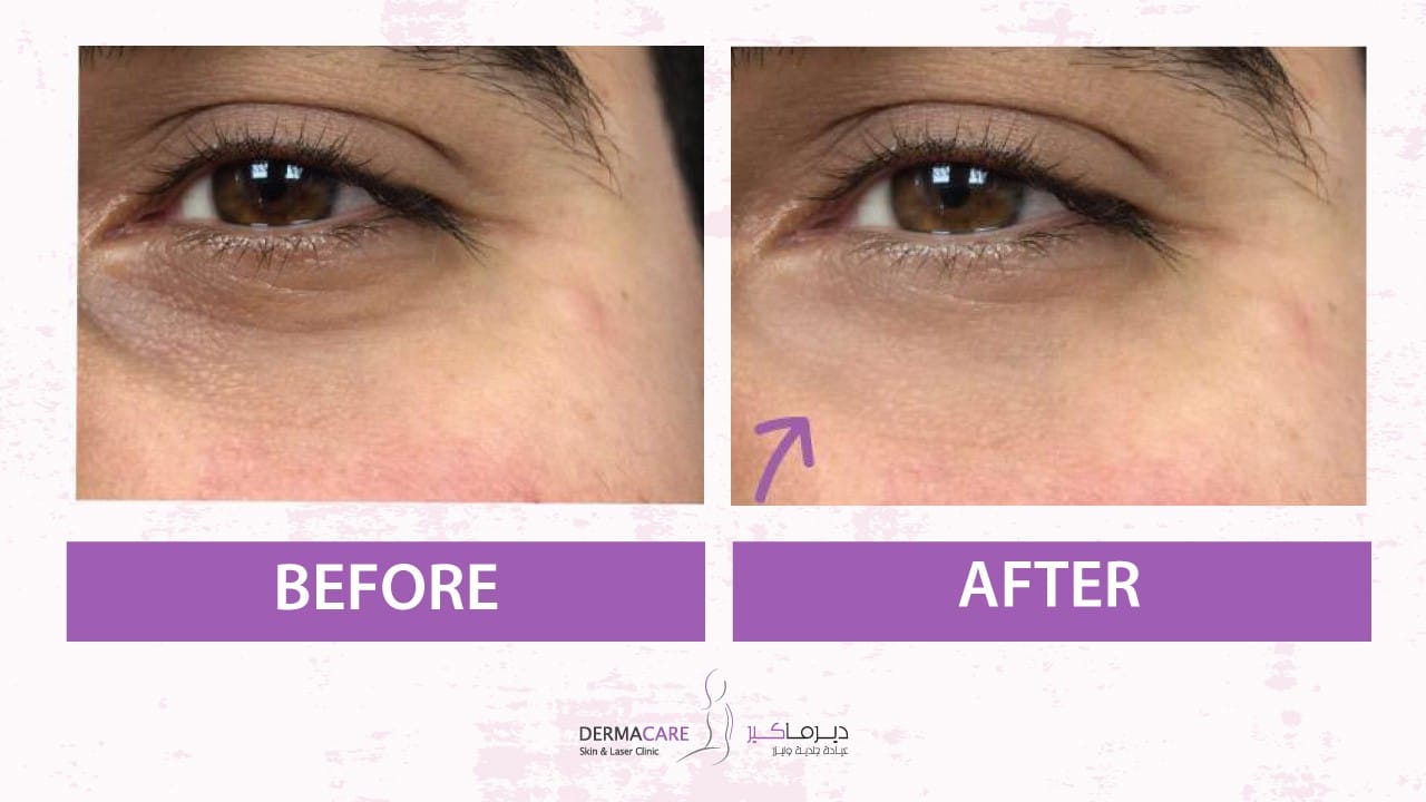 Filler Treatment