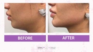 Chin and Jawline Treatement