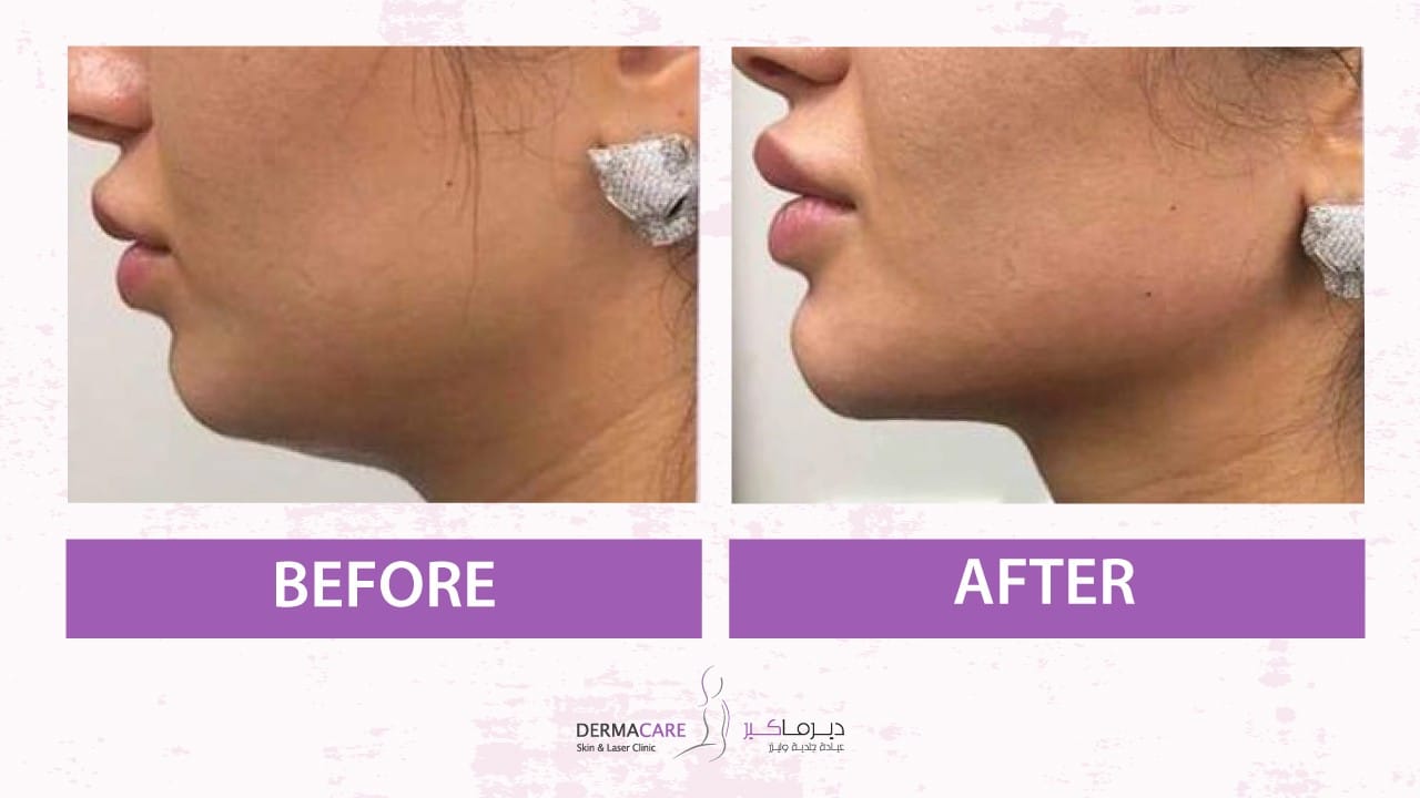 Chin and Jawline Treatement