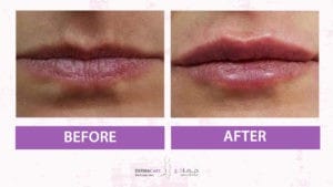 Filler Treatment