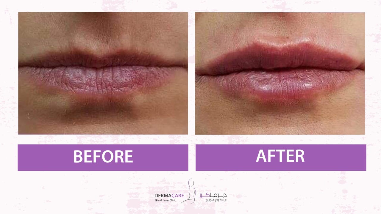 Filler Treatment