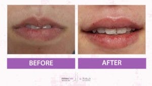 Filler Treatment