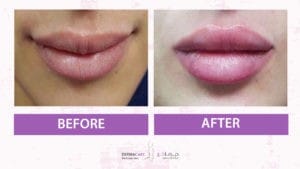 Filler Treatment