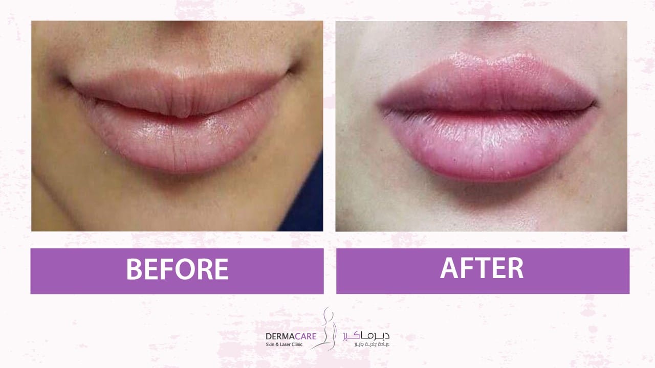 Filler Treatment