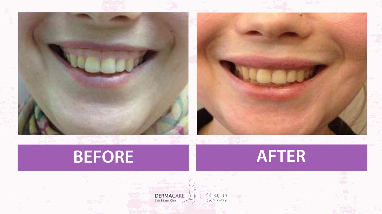 Botox Treatment