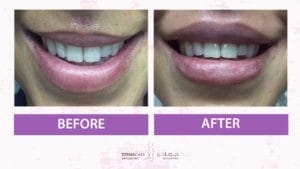 Filler Treatment