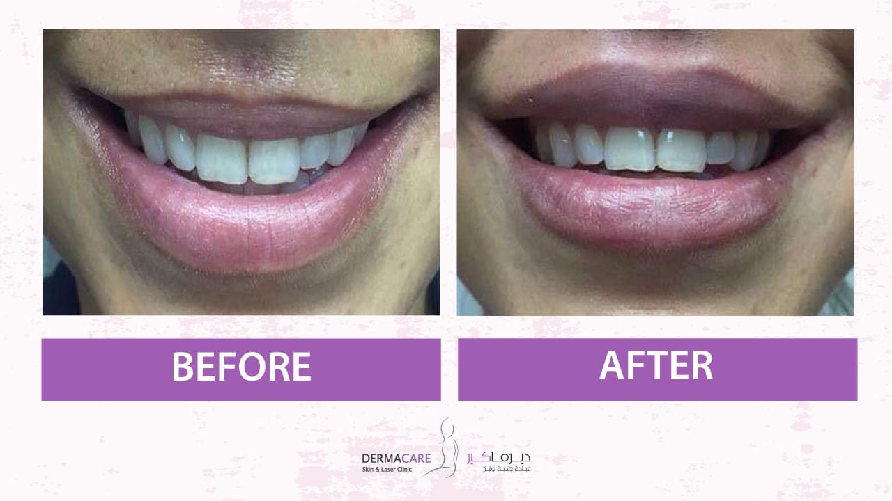 Filler Treatment