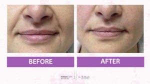 Filler Treatment