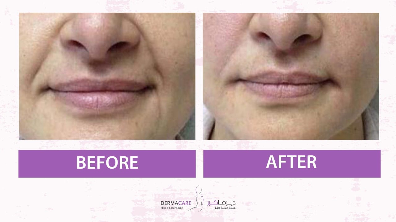 Filler Treatment