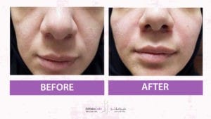 Filler Treatment