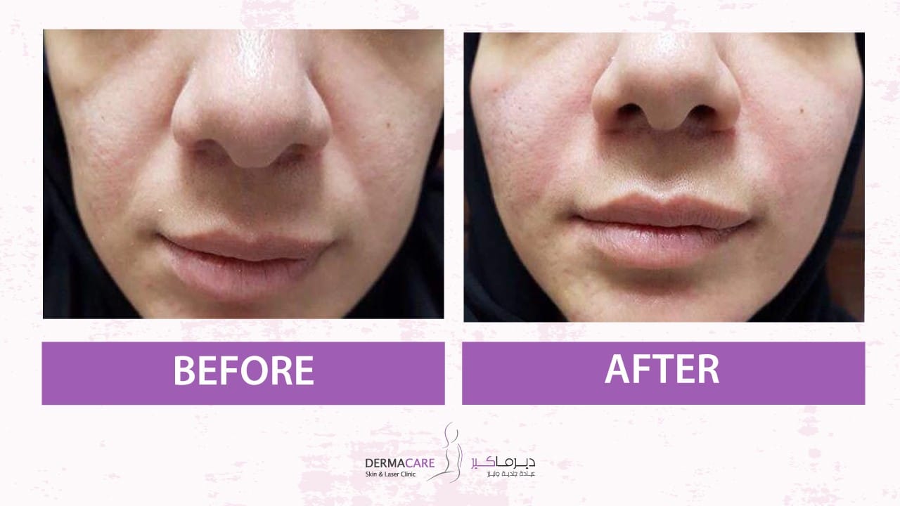 Filler Treatment