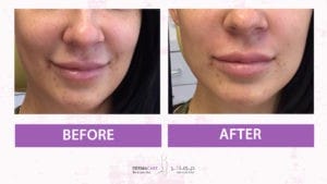 Filler Treatment