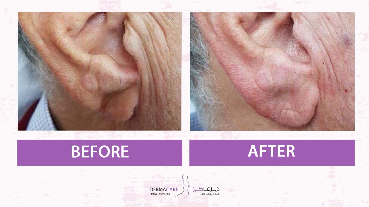 Filler Treatment