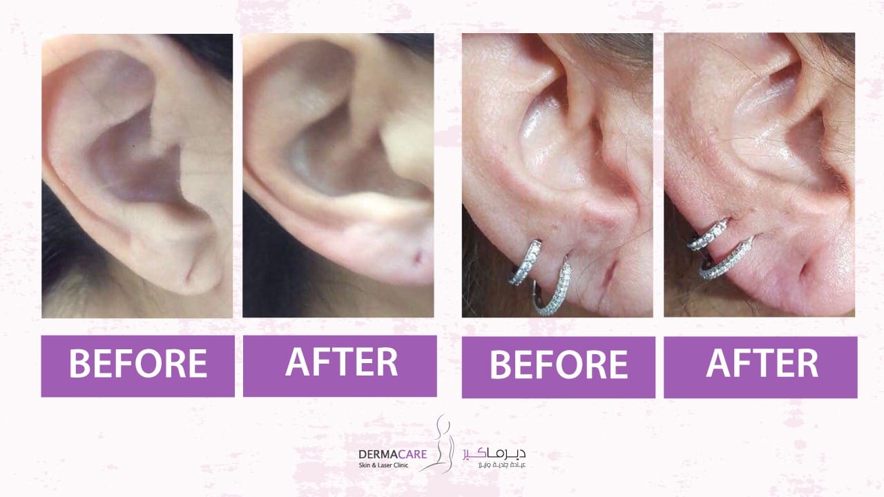 Filler Treatment