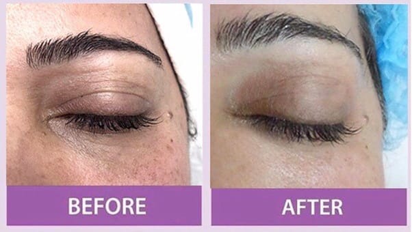 Eyelid treatment - Image 2