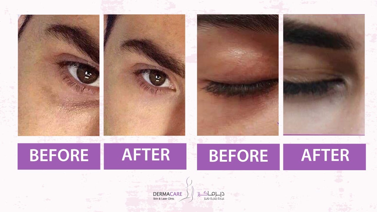 Filler Treatment