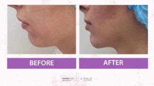 Chin and Jawline Treatement