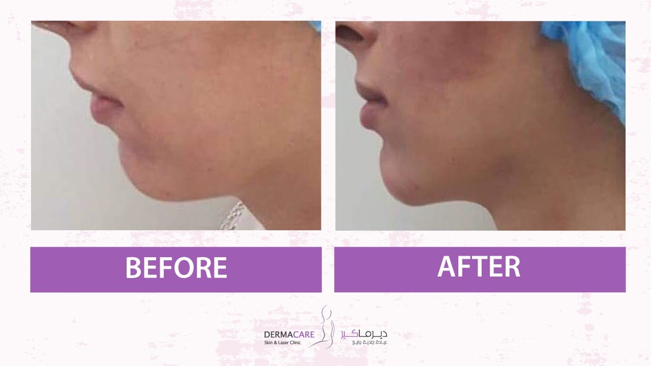 Chin and Jawline Treatement