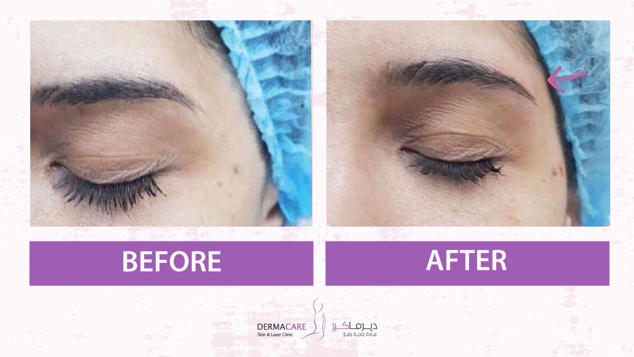 Filler Treatment
