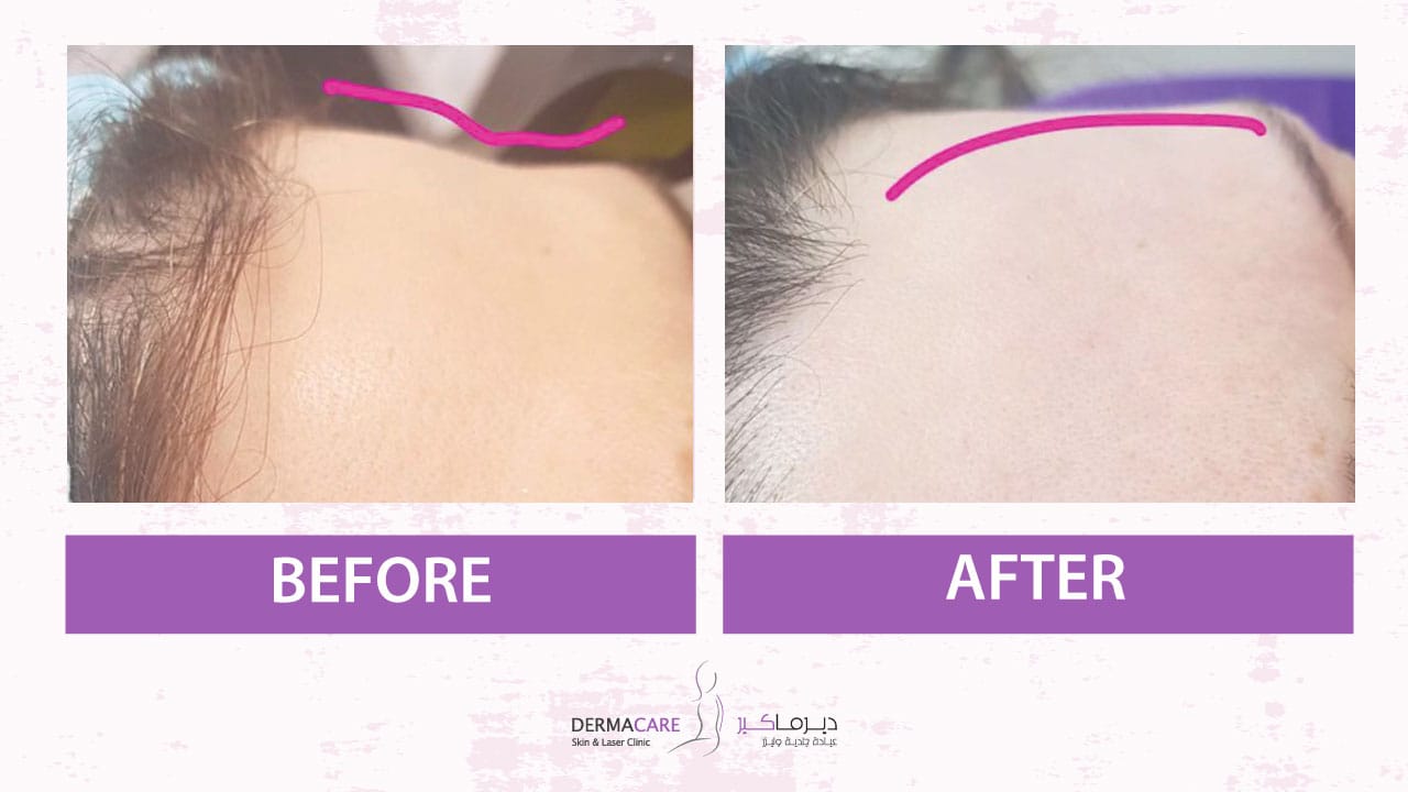 Filler Treatment