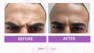 Botox Treatement