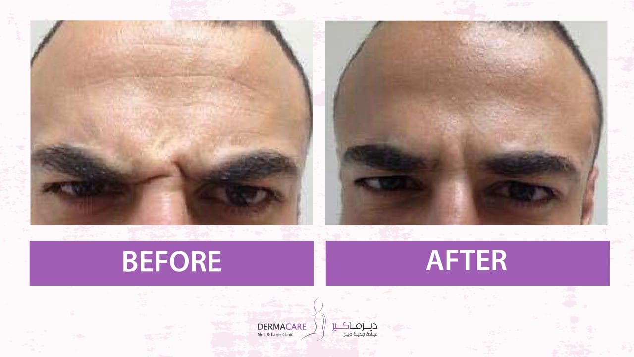 Botox Treatement