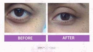 Filler Treatment