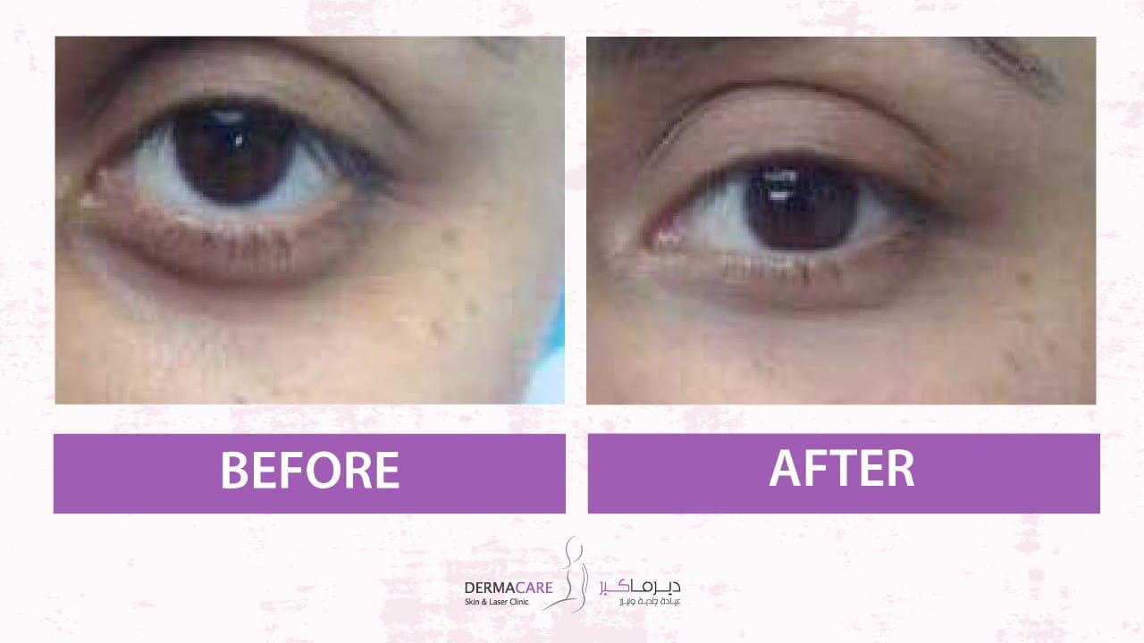 Filler Treatment