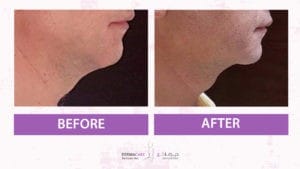 Chin and Jawline Treatement