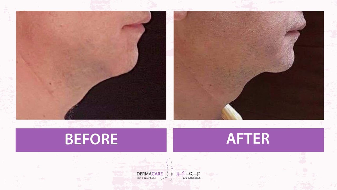 Chin and Jawline Treatement