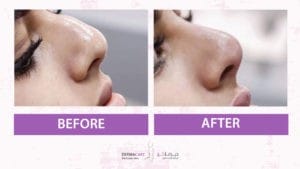 Filler Treatment