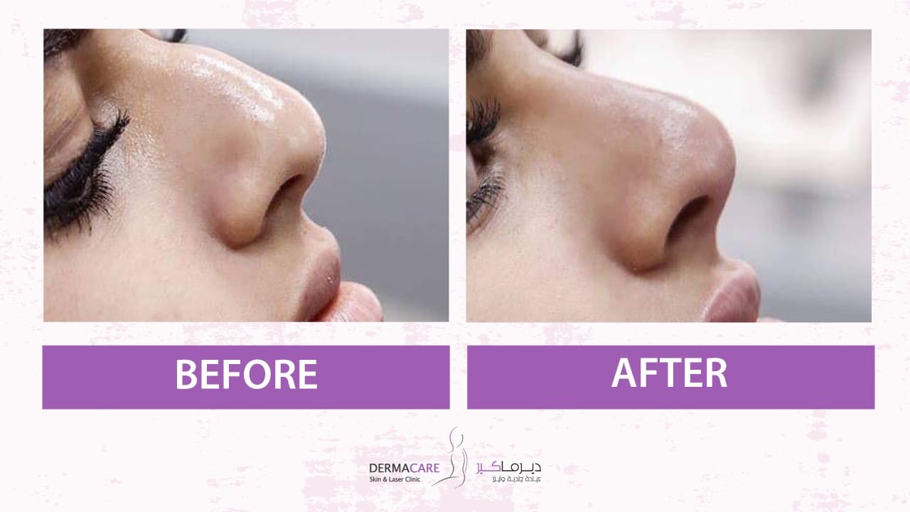 Filler Treatment