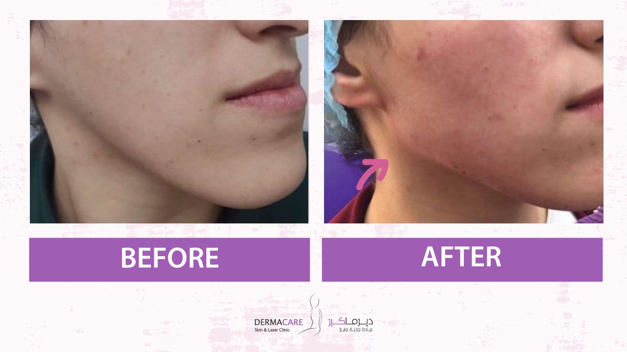 Chin and Jawline Treatement