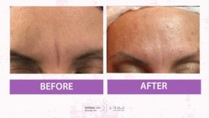 Botox Treatement