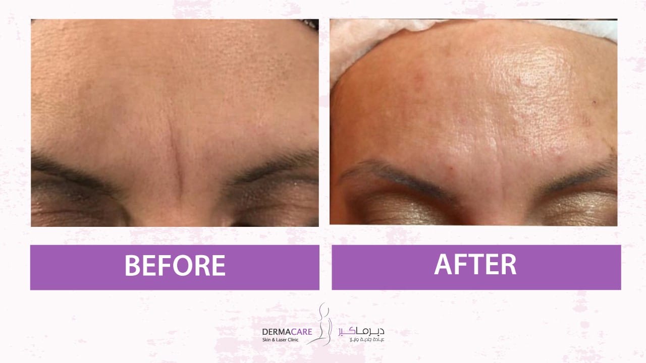 Botox Treatement