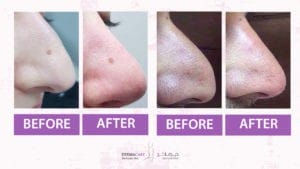 Filler Treatment