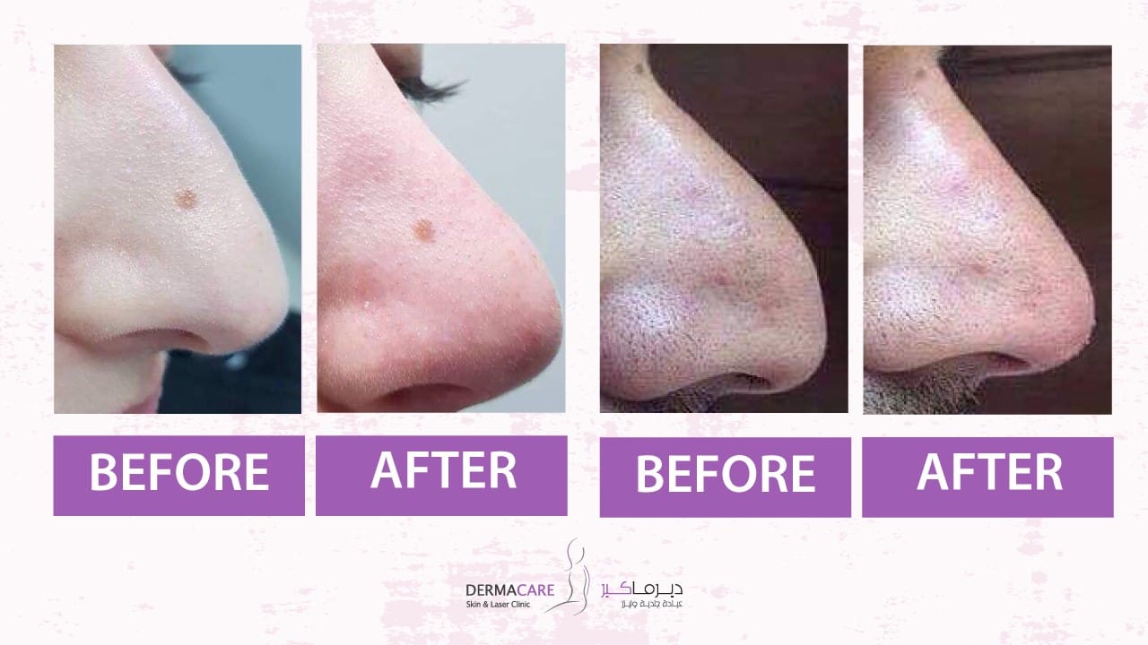 Filler Treatment