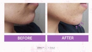 Chin and Jawline Treatement