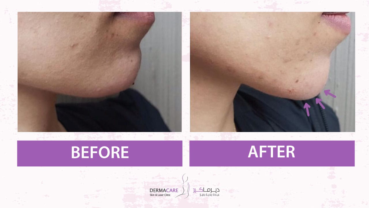 Chin and Jawline Treatement