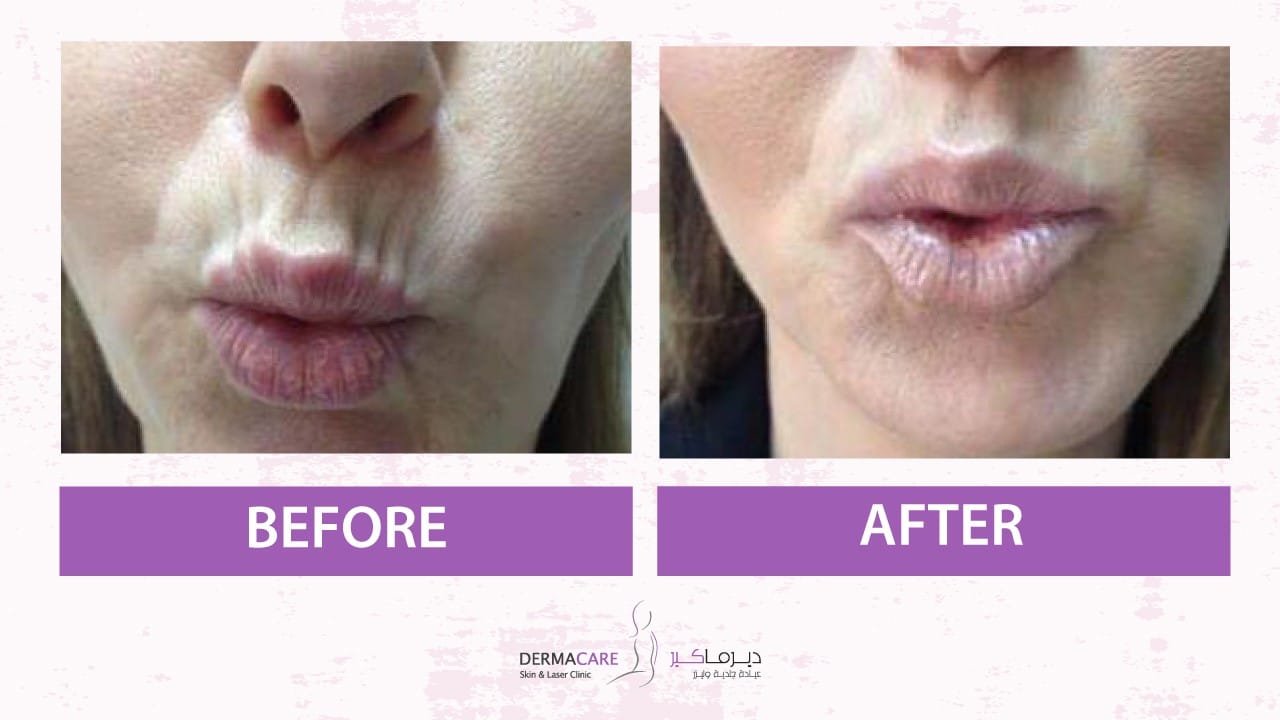 Botox Treatement