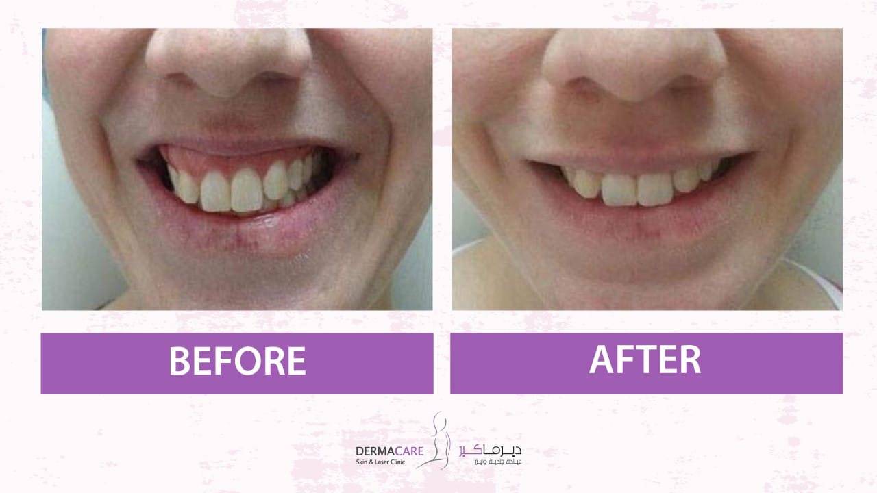 Botox Treatement