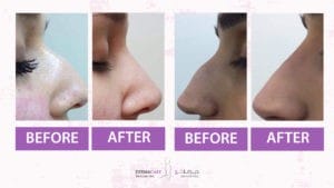 Filler Treatment