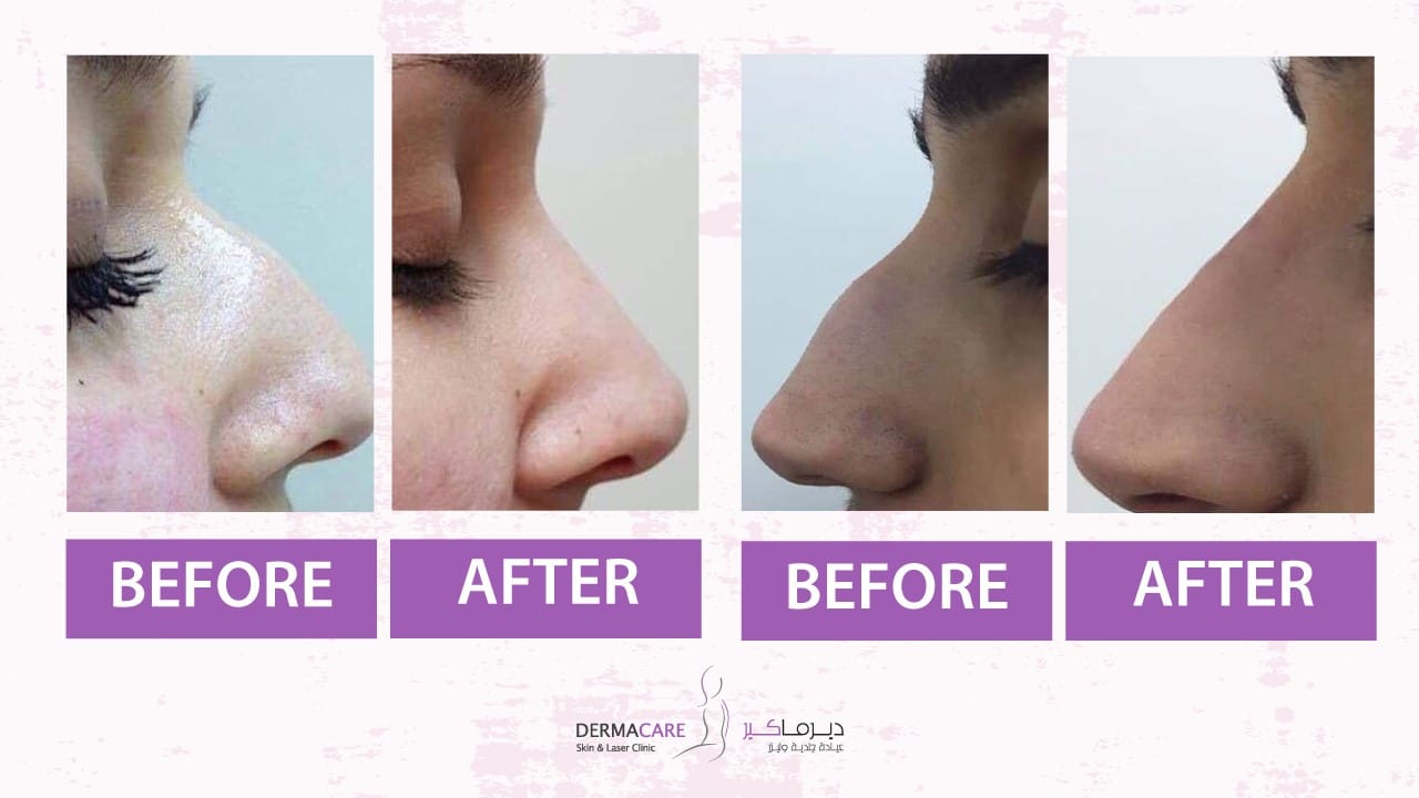 Filler Treatment