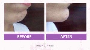 Chin and Jawline Treatement