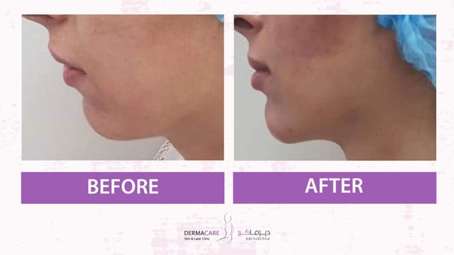 Chin augmentation - Image 2