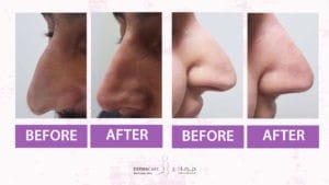 Filler Treatment