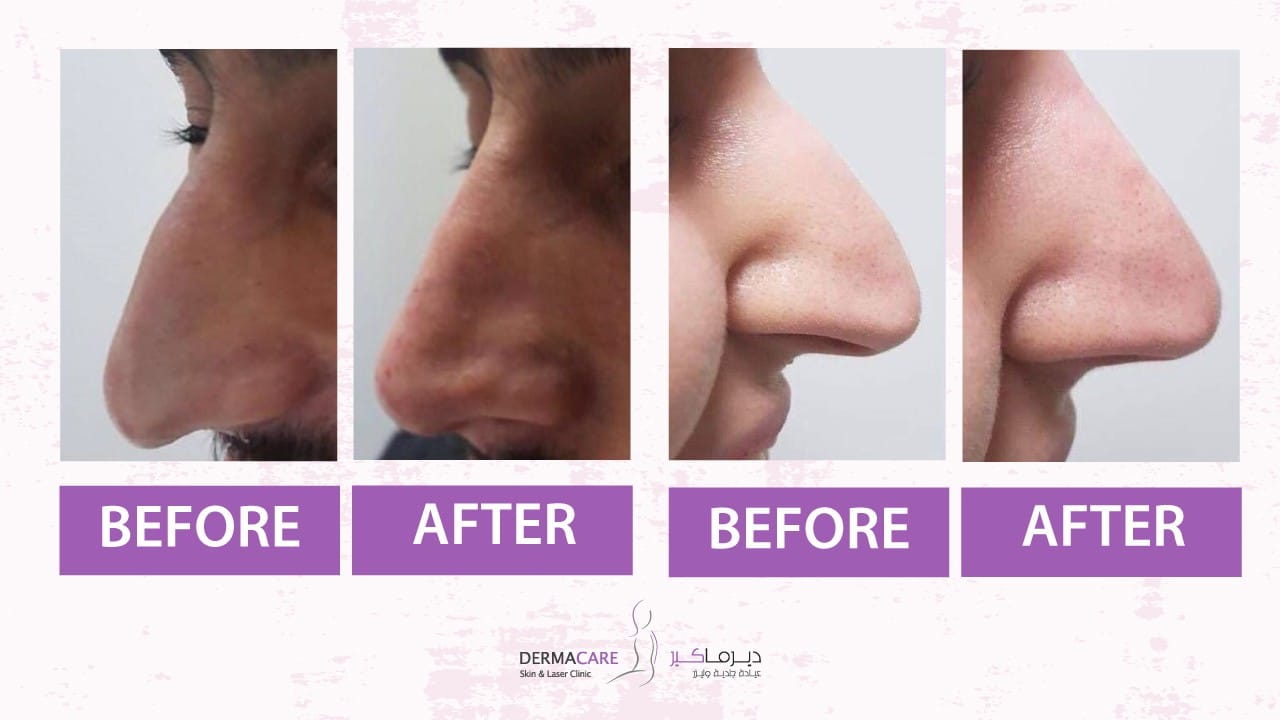 Filler Treatment